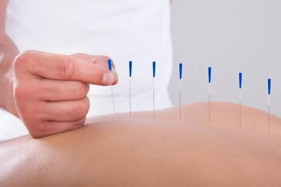 benefits of acupuncture