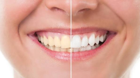 natural teeth whitening at home
